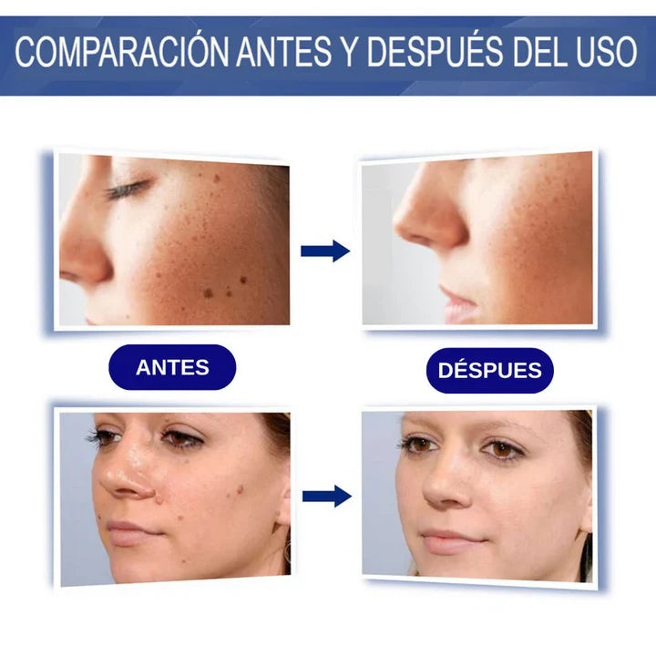Crema para Eliminar Verrugas – Solución Natural y Efectiva para una Piel Impecable