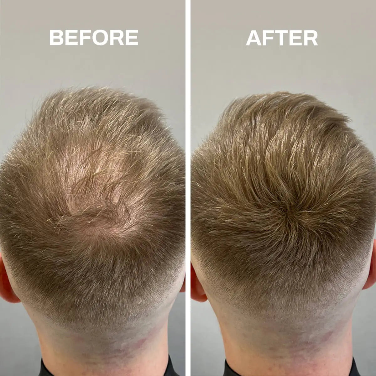 Fibras Capilares para Cabello Escaso – Volumen Instantáneo, Confianza Renovada